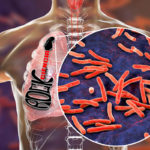 Tuberculose (S11E11)